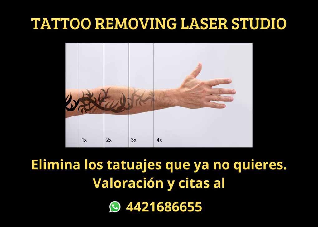 Elimina tus tatuajes de forma segura con láser - LCV Informa